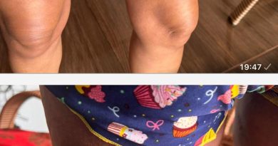 Erro em Medicação: Paciente de Santa Fé do Sul Sofre Reação Alérgica Grave Após Internação por Hemorragia