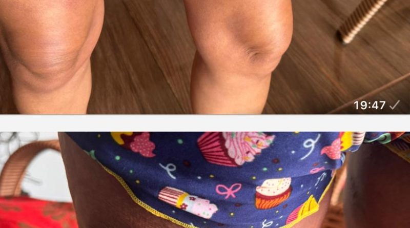 Erro em Medicação: Paciente de Santa Fé do Sul Sofre Reação Alérgica Grave Após Internação por Hemorragia