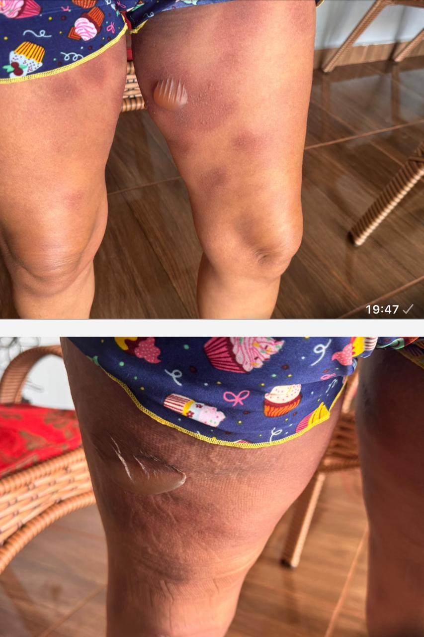 Erro em Medicação: Paciente de Santa Fé do Sul Sofre Reação Alérgica Grave Após Internação por Hemorragia